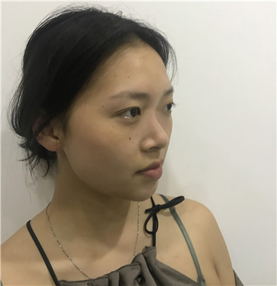 重庆联合丽格党宁鼻部手术案例价格分享,做个鼻子竟然像换头术一样神奇!