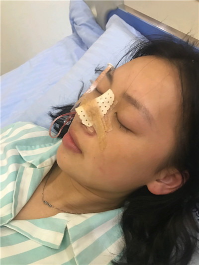 重庆联合丽格党宁鼻部手术案例价格分享,做个鼻子竟然像换头术一样神奇!