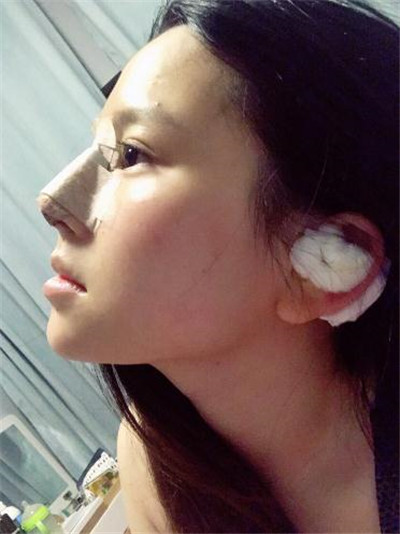 上海九院张盈帆鼻部手术案例价格分享,做完31岁阿姨竟然有小伙子搭讪了!