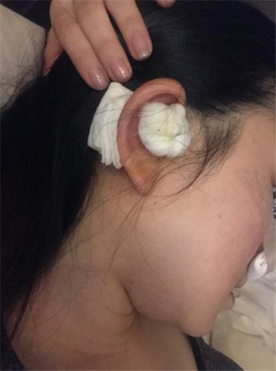 上海九院张盈帆鼻部手术案例价格分享,做完31岁阿姨竟然有小伙子搭讪了!