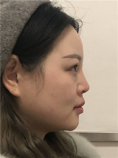 上海九院陈付国鼻部手术案例价格分享,做了鼻子桃花太旺怎么办!