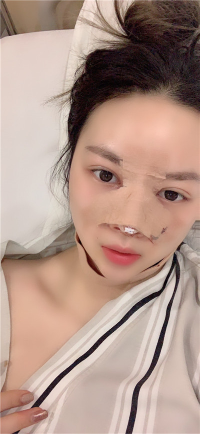 上海九院陈付国鼻部手术案例价格分享,做了鼻子桃花太旺怎么办!