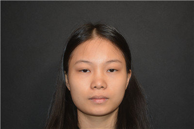 北京柏丽李劲良鼻部手术脂肪填充案例价格分享,这个小姐姐的侧颜杀真的绝了!