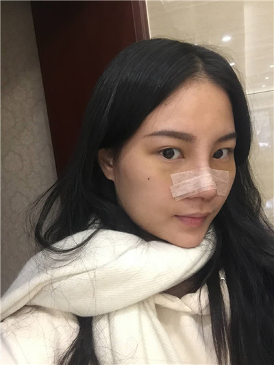 北京柏丽李劲良鼻部手术脂肪填充案例价格分享,这个小姐姐的侧颜杀真的绝了!