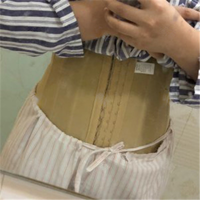上海愉悦美联臣荣峥吸脂瘦腰案例价格分享,腰细了太多显得腿都变长了!
