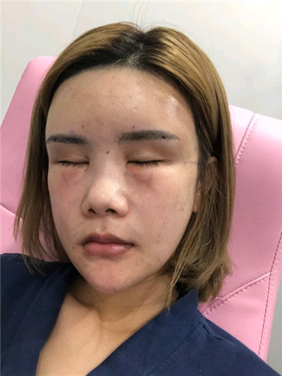 重庆铂生杜亚旭面部填充案例价格分享,我真的不是网红脸!