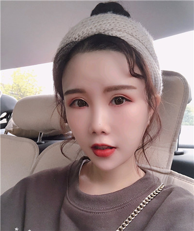 重庆铂生杜亚旭面部填充案例价格分享,我真的不是网红脸!