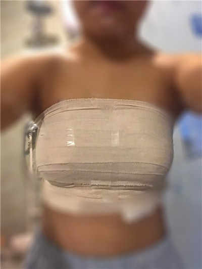 北京艺星翟红宇隆胸案例价格分享,你们的波霸姐姐又来啦~