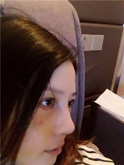 上海九院陈付国鼻部手术案例价格分享,三岁孩子的妈妈现在追求者一大堆~