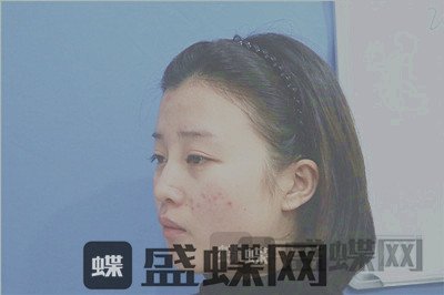杭州格莱美张龙鼻部手术案例价格分享,看照片我说显年轻十岁你信吗?