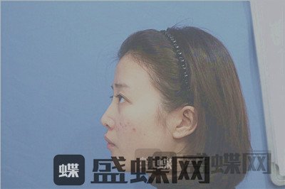 杭州格莱美张龙鼻部手术案例价格分享,看照片我说显年轻十岁你信吗?