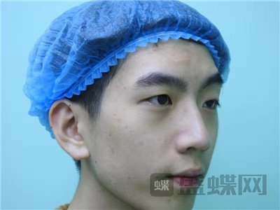 原上海九院王维眼部手术案例价格分享,同学们说我做完像韩国欧巴~
