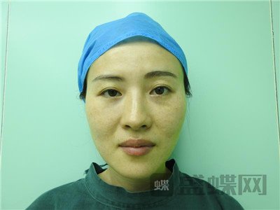 北京百达丽苏婷眼部手术案例价格分享,老阿姨变身小姐姐超开心~~
