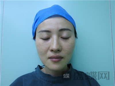 北京百达丽苏婷眼部手术案例价格分享,老阿姨变身小姐姐超开心~~