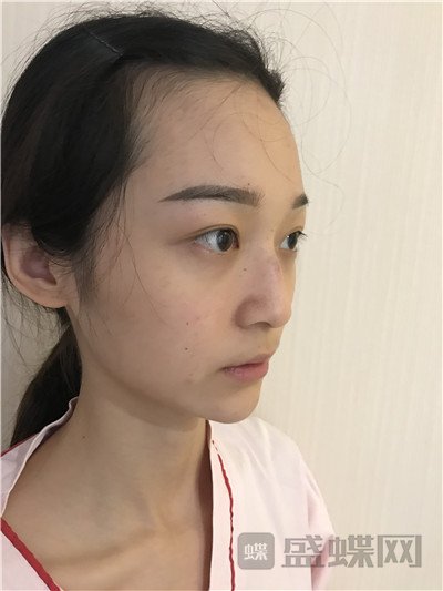 上海百达丽沈国雄隆鼻案例价格分享,较好看的鼻子没有之一~
