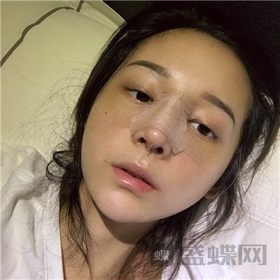 上海百达丽沈国雄隆鼻案例价格分享,较好看的鼻子没有之一~
