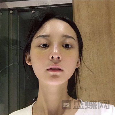 上海百达丽沈国雄隆鼻案例价格分享,较好看的鼻子没有之一~
