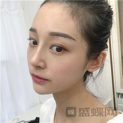 上海百达丽沈国雄隆鼻案例价格分享,较好看的鼻子没有之一~