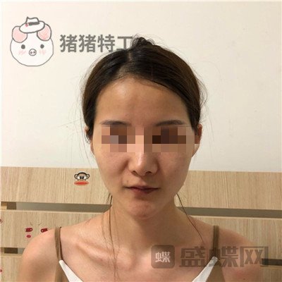 福州美贝尔原上海九院赵栋材面部填充案例价格分享,做完皮肤感觉在发光~~
