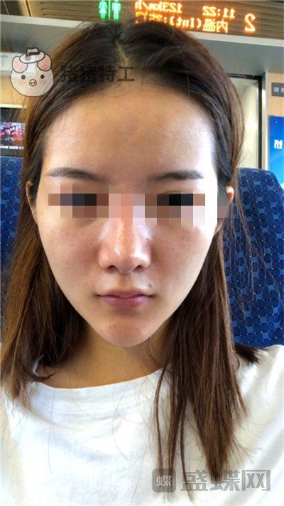福州美贝尔原上海九院赵栋材面部填充案例价格分享,做完皮肤感觉在发光~~