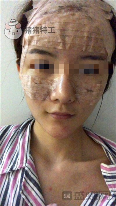福州美贝尔原上海九院赵栋材面部填充案例价格分享,做完皮肤感觉在发光~~