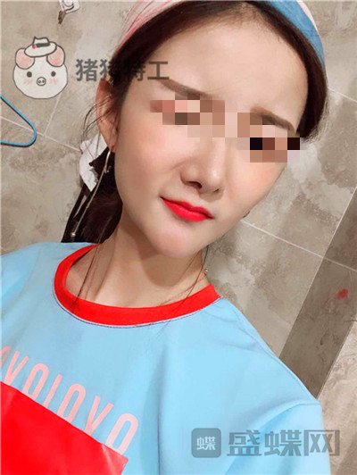 福州美贝尔原上海九院赵栋材面部填充案例价格分享,做完皮肤感觉在发光~~