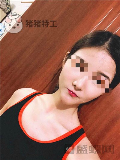 福州美贝尔原上海九院赵栋材面部填充案例价格分享,做完皮肤感觉在发光~~