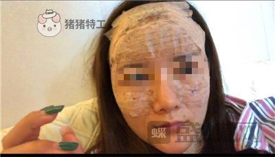 福州美贝尔原上海九院赵栋材面部填充案例价格分享,做完皮肤感觉在发光~~