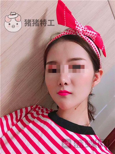 福州美贝尔原上海九院赵栋材面部填充案例价格分享,做完皮肤感觉在发光~~