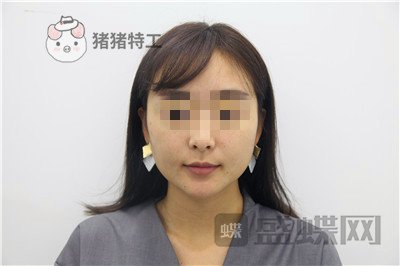 北京俊泰丽格薛志强埋线提升案例价格分享,脸瞬间就小了整整两圈有图有真相~!