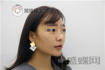北京俊泰丽格薛志强埋线提升案例价格分享,脸瞬间就小了整整两圈有图有真相~!