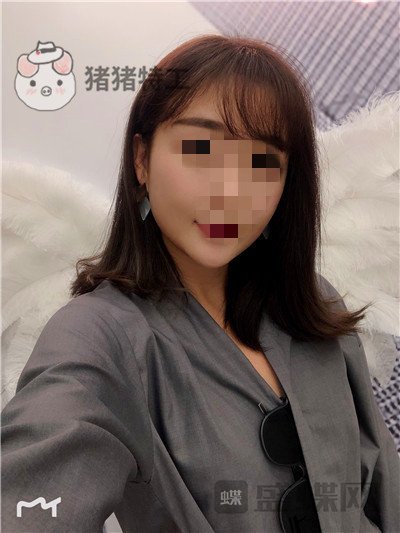 北京俊泰丽格薛志强埋线提升案例价格分享,脸瞬间就小了整整两圈有图有真相~!