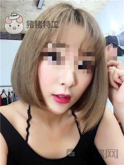 北京俊泰丽格薛志强埋线提升案例价格分享,脸瞬间就小了整整两圈有图有真相~!