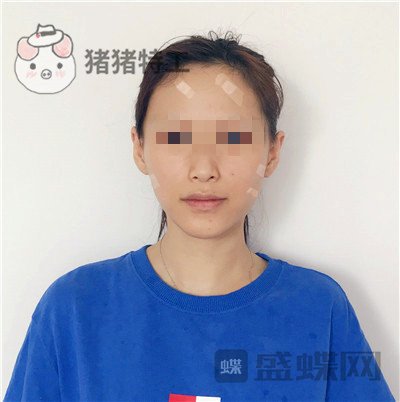 哈尔滨美联致美侯锋玉面部填充案例价格分享,现在我就像一个高中生~