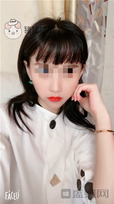 哈尔滨美联致美侯锋玉面部填充案例价格分享,现在我就像一个高中生~