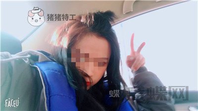 哈尔滨美联致美侯锋玉面部填充案例价格分享,现在我就像一个高中生~