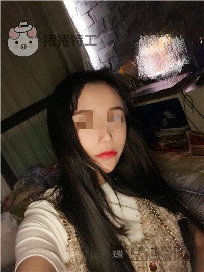 哈尔滨美联致美侯锋玉面部填充案例价格分享,现在我就像一个高中生~