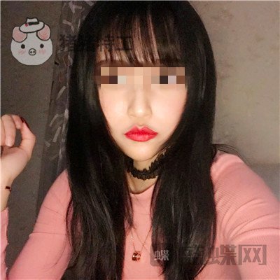 哈尔滨美联致美侯锋玉面部填充案例价格分享,现在我就像一个高中生~
