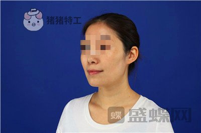 重庆华美陈凯面部填充案例价格分享,妈妈变成姐姐的惊奇改变!