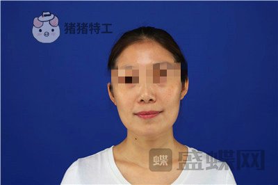 重庆华美陈凯面部填充案例价格分享,妈妈变成姐姐的惊奇改变!