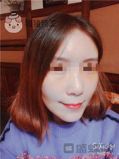 重庆华美陈凯面部填充案例价格分享,妈妈变成姐姐的惊奇改变!