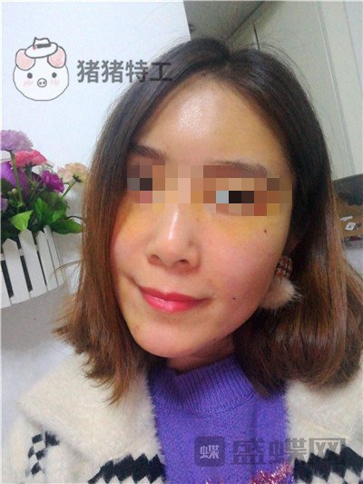 重庆华美陈凯面部填充案例价格分享,妈妈变成姐姐的惊奇改变!