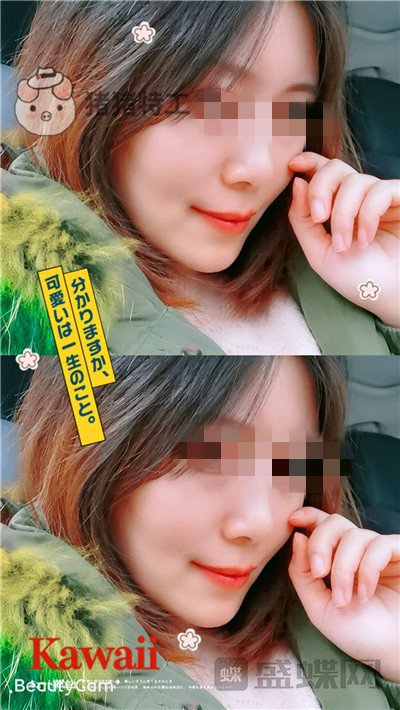 重庆华美陈凯面部填充案例价格分享,妈妈变成姐姐的惊奇改变!