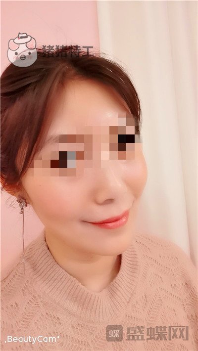 重庆华美陈凯面部填充案例价格分享,妈妈变成姐姐的惊奇改变!