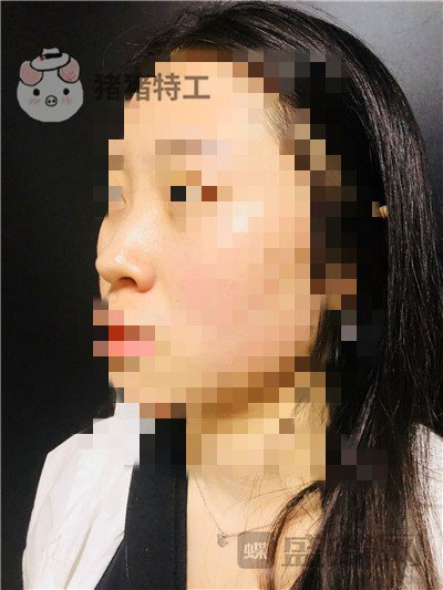 长沙艺星秦晓东隆鼻案例价格分享,这个颜值可以当网红了!