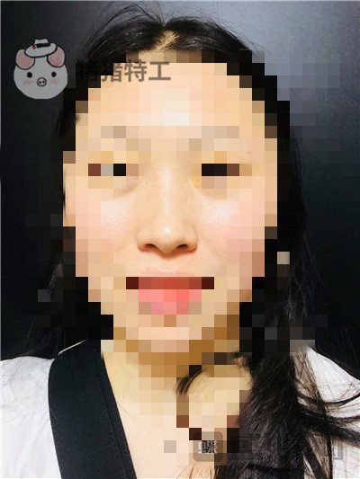 长沙艺星秦晓东隆鼻案例价格分享,这个颜值可以当网红了!