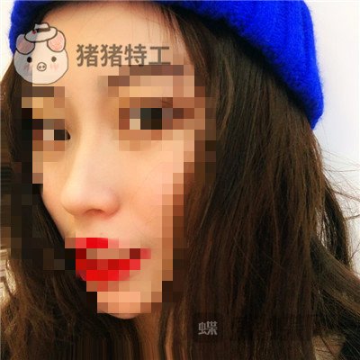 长沙艺星秦晓东隆鼻案例价格分享,这个颜值可以当网红了!