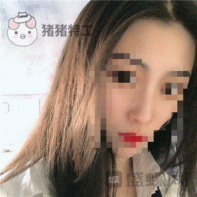 长沙艺星秦晓东隆鼻案例价格分享,这个颜值可以当网红了!