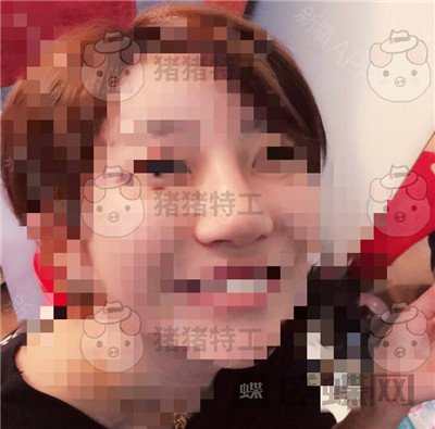 上海九院张盈帆鼻修复案例价格分享,平面模特小姐姐的鼻修复之路~