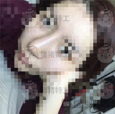 上海九院张盈帆鼻修复案例价格分享,平面模特小姐姐的鼻修复之路~